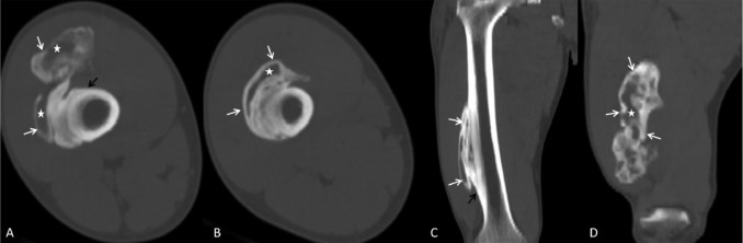 TC de osificación heterotópica
