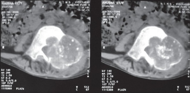 TC de osteoblastoma