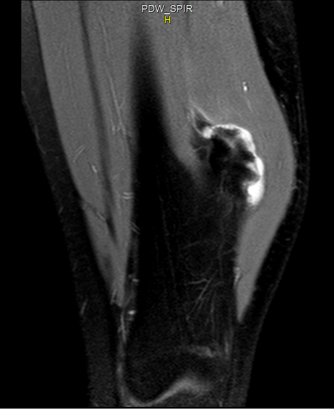 Radiografía de osteocondroma