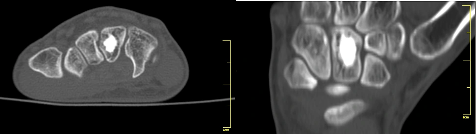 TC de osteoma
