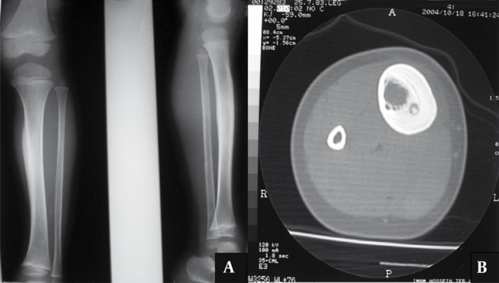 TC de osteoma osteoide