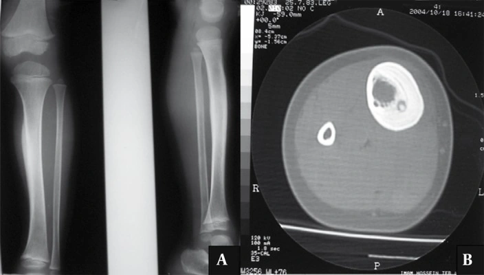 TC de osteoma osteoide