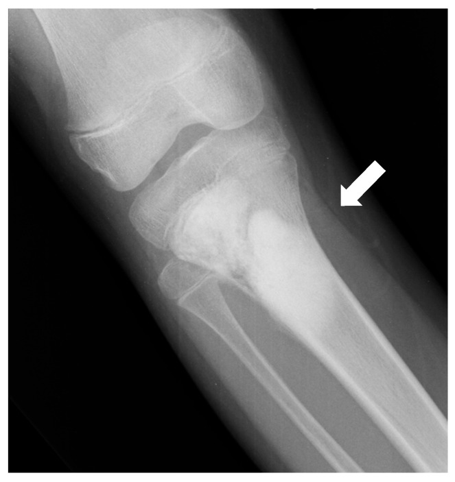 Radiografía de osteosarcoma