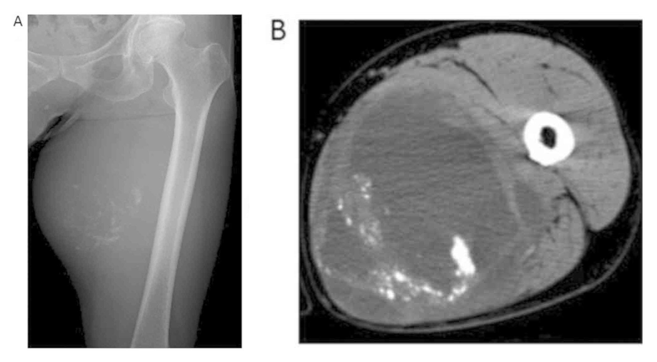 TC de osteosarcoma extraesquelético