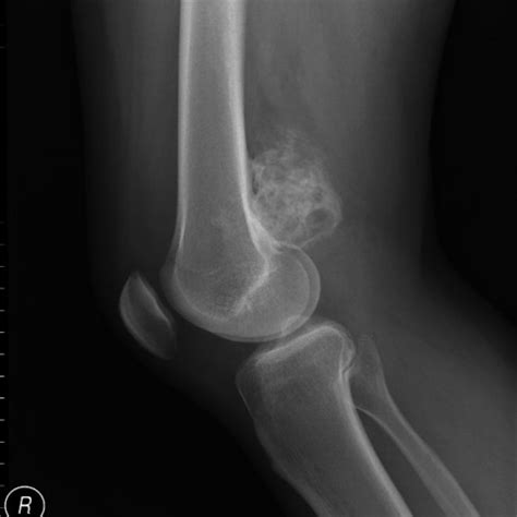 Radiografía de osteosarcoma
