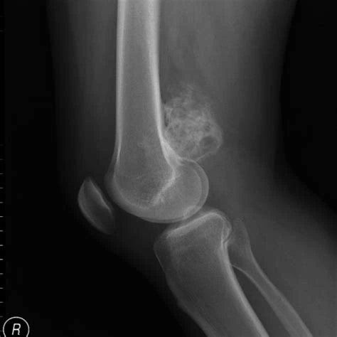 Radiografía de osteosarcoma