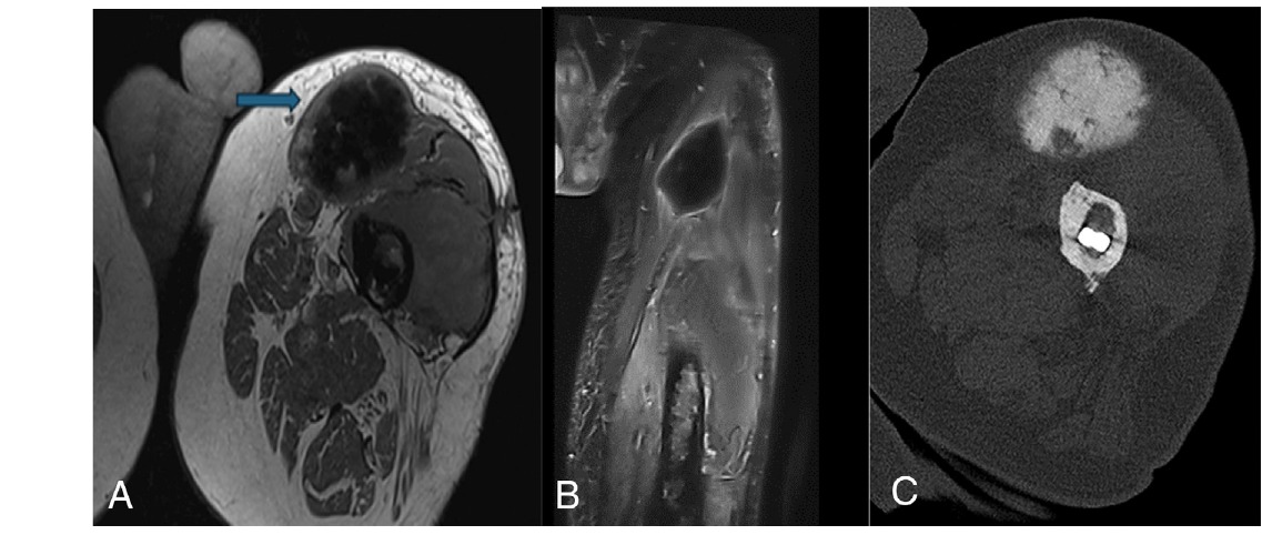 Osteosarcoma secundario radioinducido del muslo con masa osificante