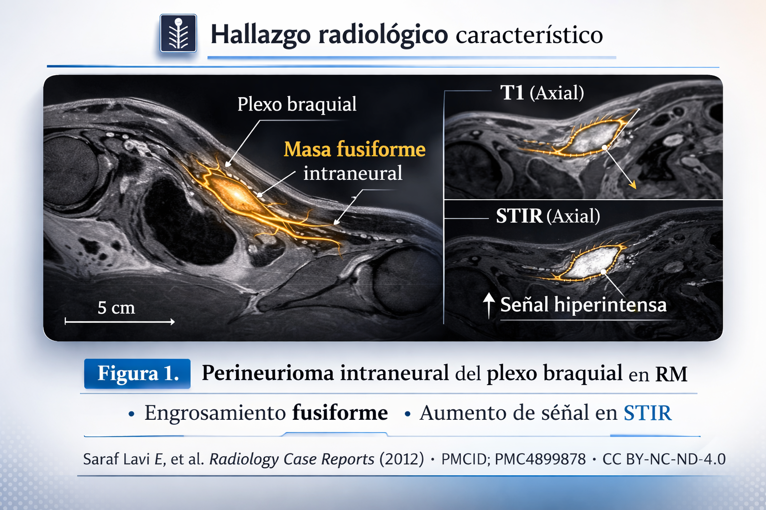 RM de perineurioma