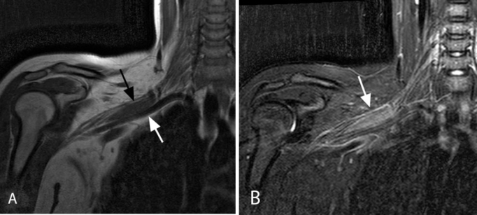 RM de perineurioma intraneural del plexo braquial