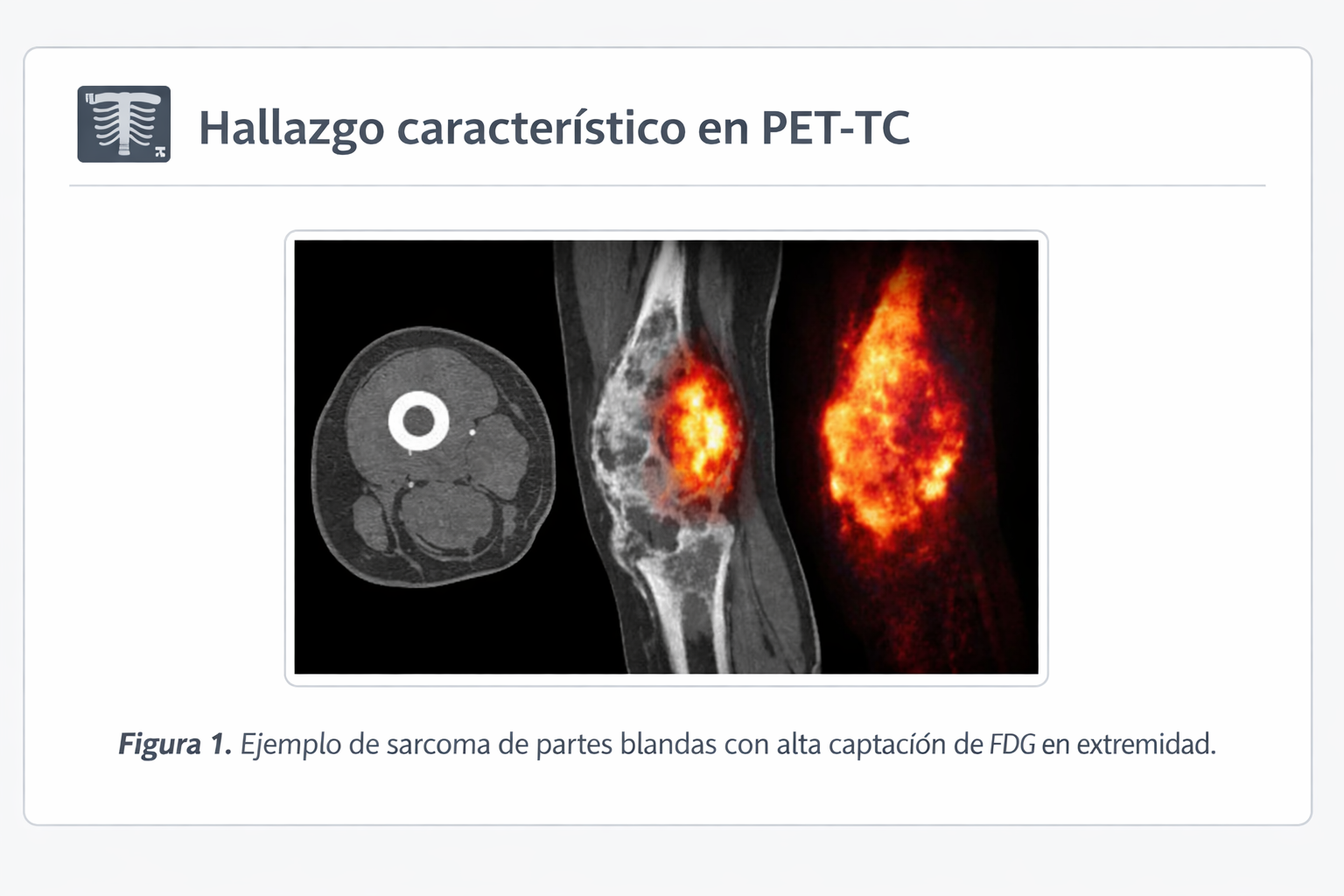 PET-TC de sarcoma