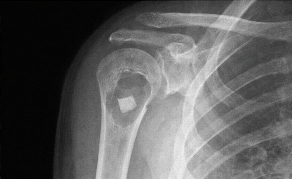 Radiografía de quiste óseo unicameral