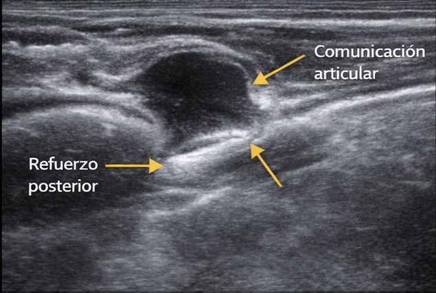 Ecografía de quiste sinovial