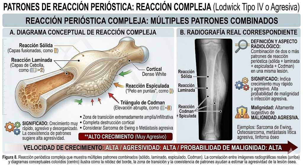 Reacción perióstica compleja