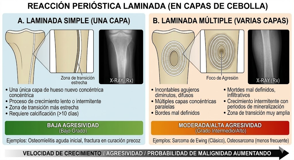 Reacción perióstica laminada simple