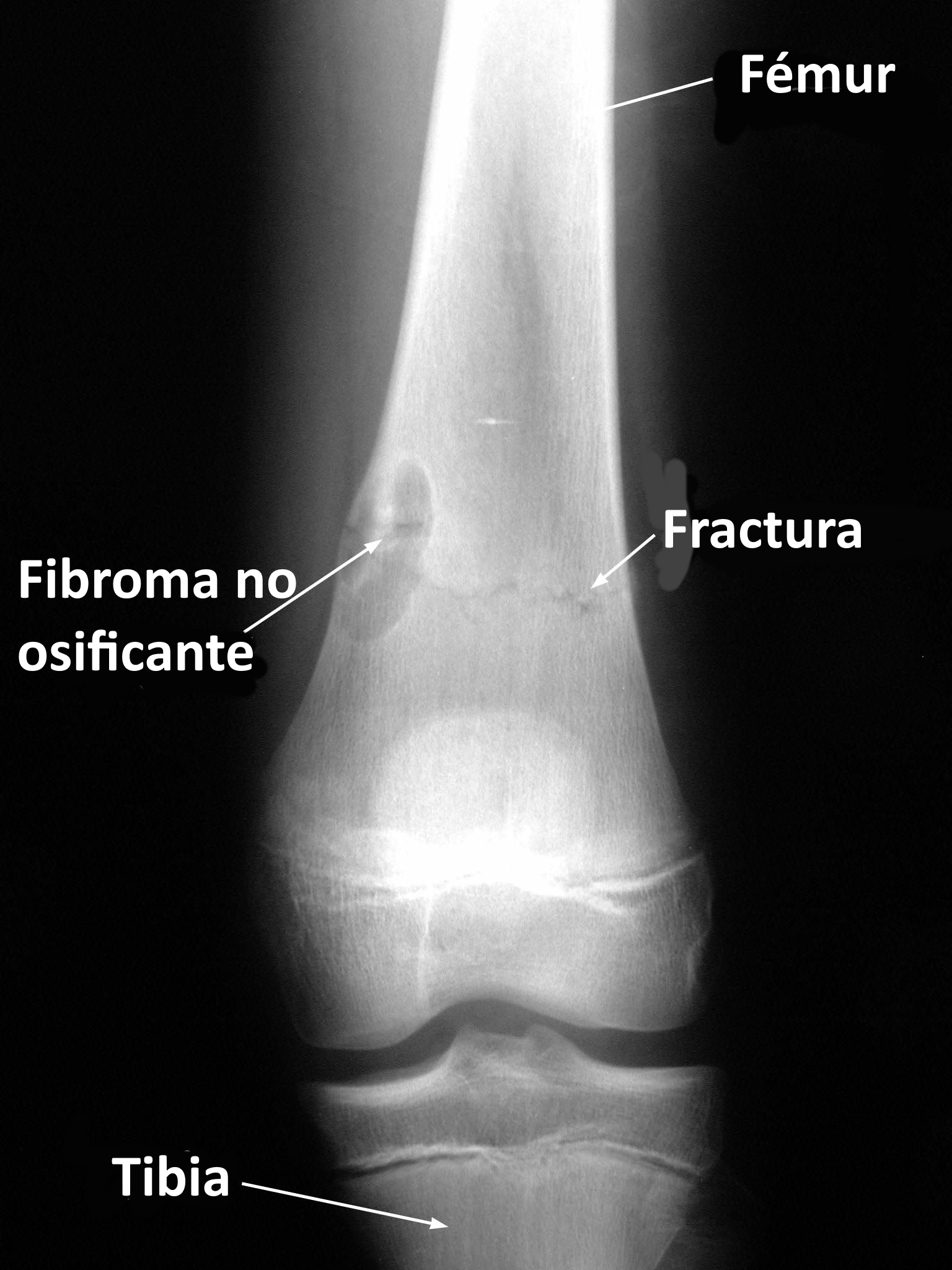 Radiografía: lesión lítica excéntrica metafisaria con borde esclerótico, típica de fibroma no osificante