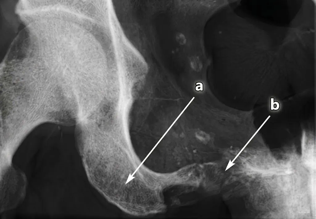RM de sarcoma con diferenciación heteróloga