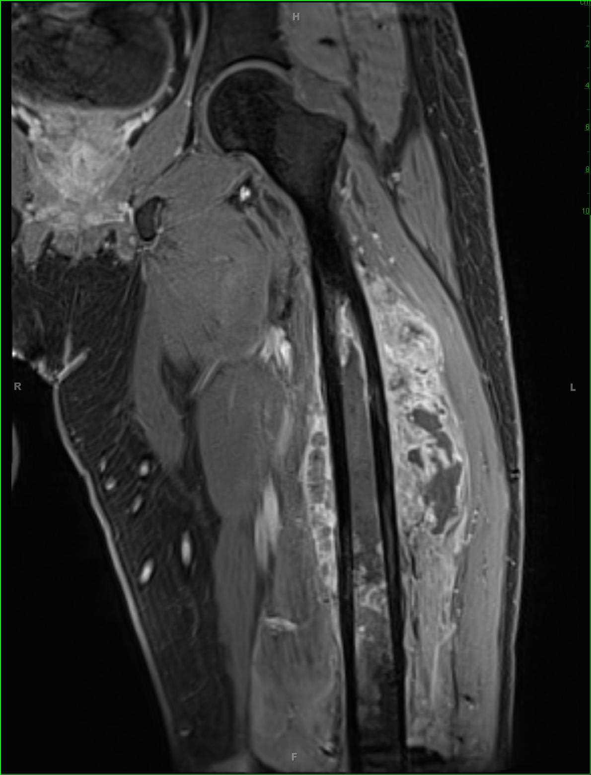 RM de sarcoma de Ewing