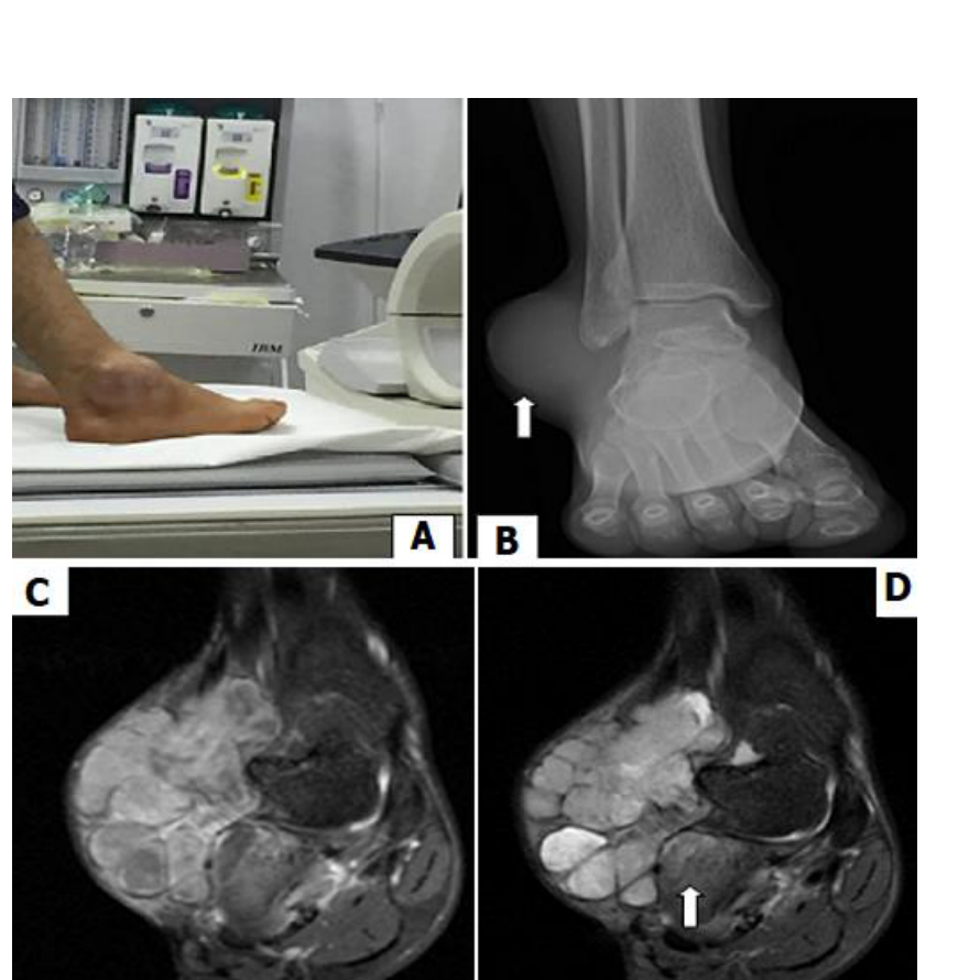 RM de sarcoma sinovial