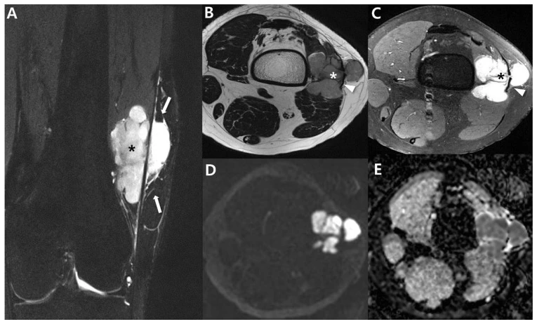RM de sarcoma de partes blandas