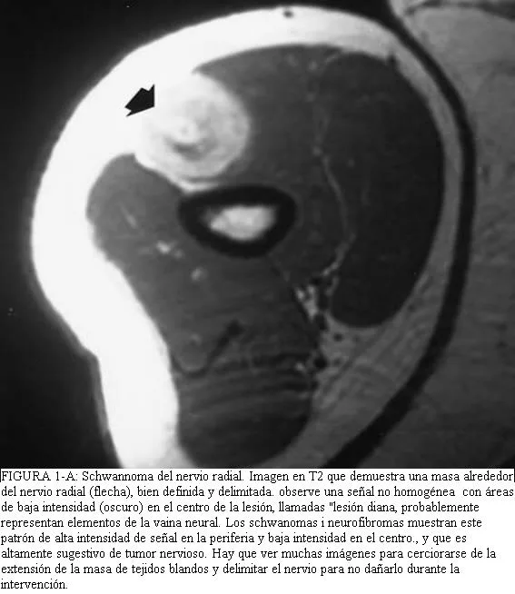 RM de schwannoma