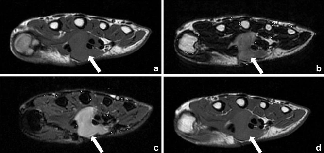 RM de tumor de células gigantes de la vaina tendinosa