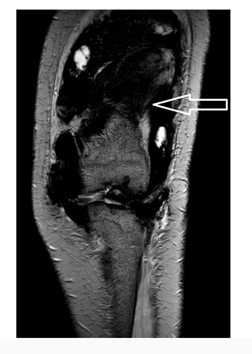RM de sinovitis vellonodular pigmentada