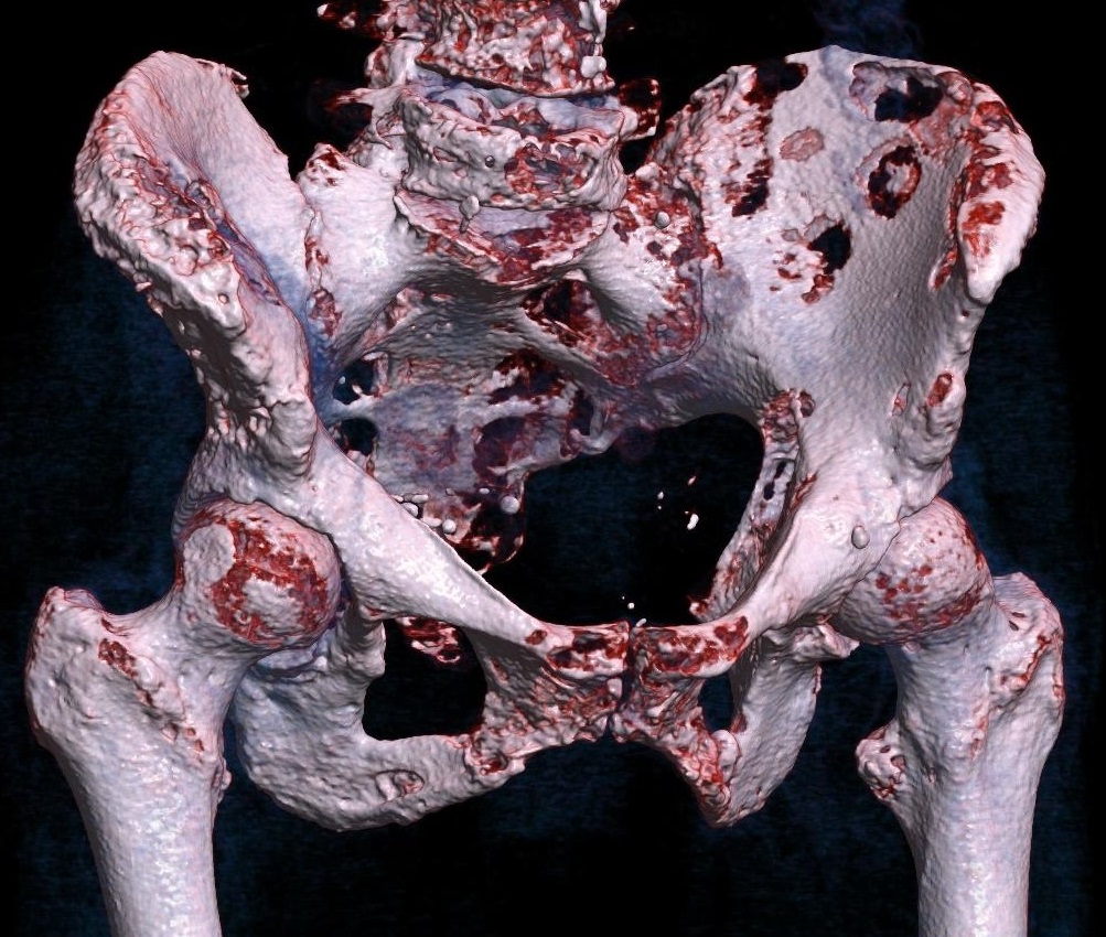TC de osteosarcoma