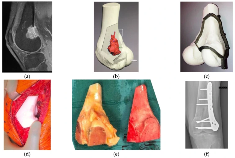Planificación quirúrgica de tumor óseo