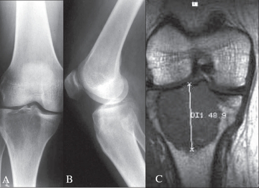 Radiografía de tumor de células gigantes del hueso en tibia proximal
