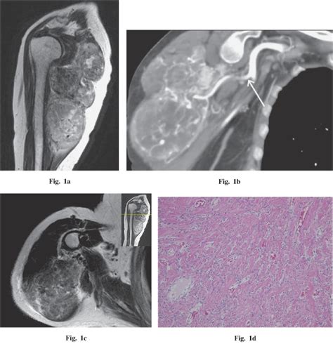 RM de tumor solitario fibroso de partes blandas