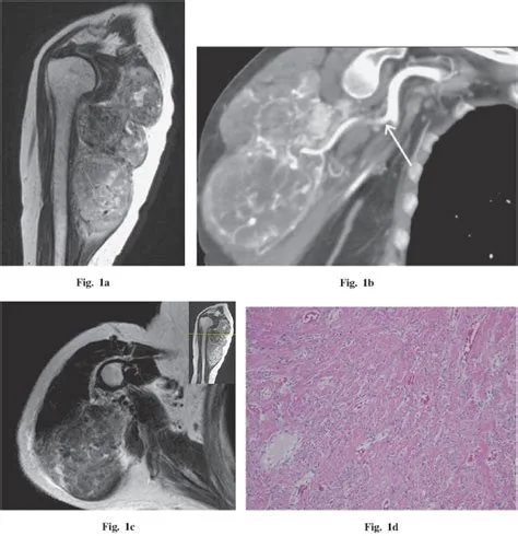 RM de tumor solitario fibroso de partes blandas