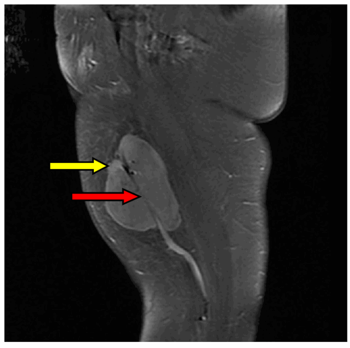 RM de tumor muscular