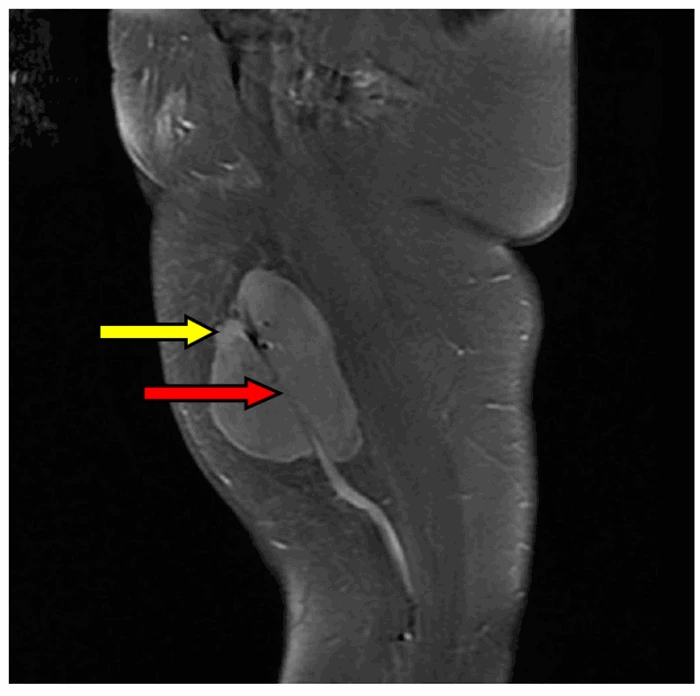 RM de tumor muscular