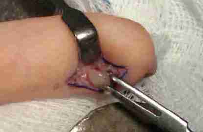 Exposición y extracción quirúrgica de tumor glómico subungueal